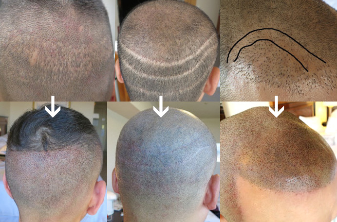 植毛とヘアタトゥーとの相性は抜群