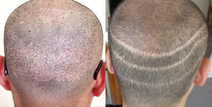 FUTやFUE法による後頭部の虫食い