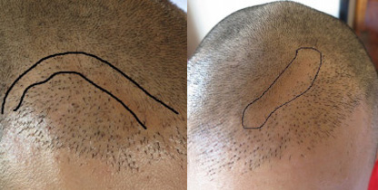 経年による自然脱毛のギャップ