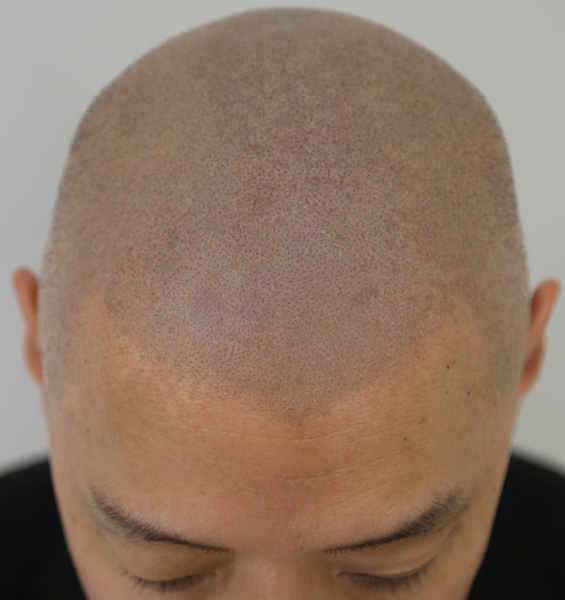 ヘアタトゥーは究極の薄毛対策