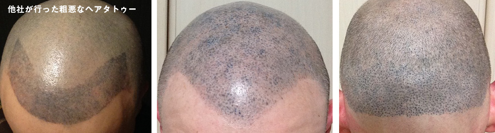 他業者が施術したヘアタトゥー